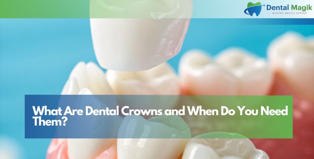 What Are Dental Crowns and When Do You Need Them?