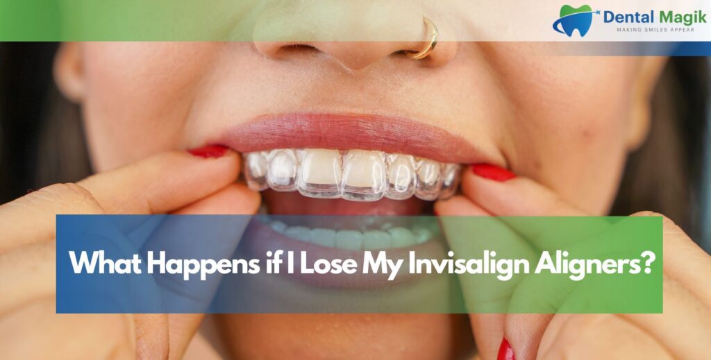 What Happens if I Lose My Invisalign Aligners?
