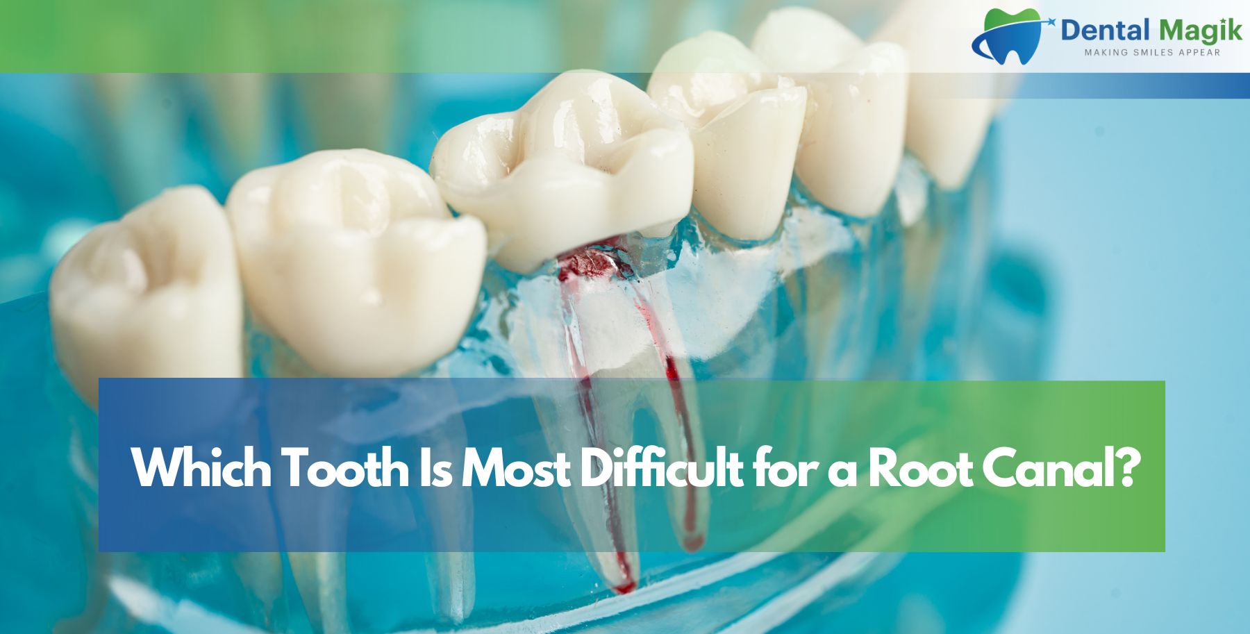 Which Tooth Is Most Difficult for a Root Canal?