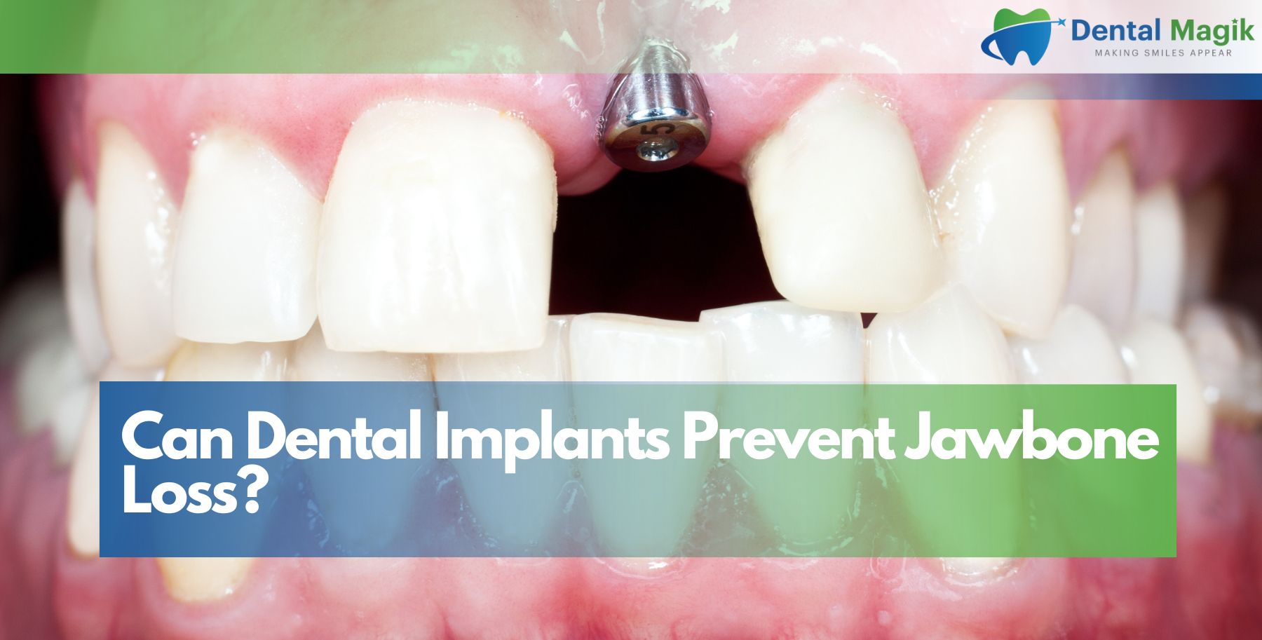 Can Dental Implants Prevent Jawbone Loss?
