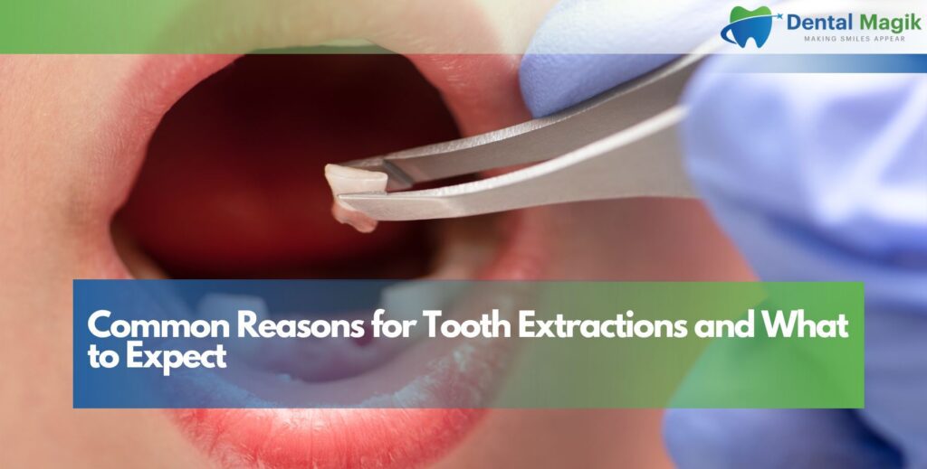Common Reasons for Tooth Extractions and What to Expect