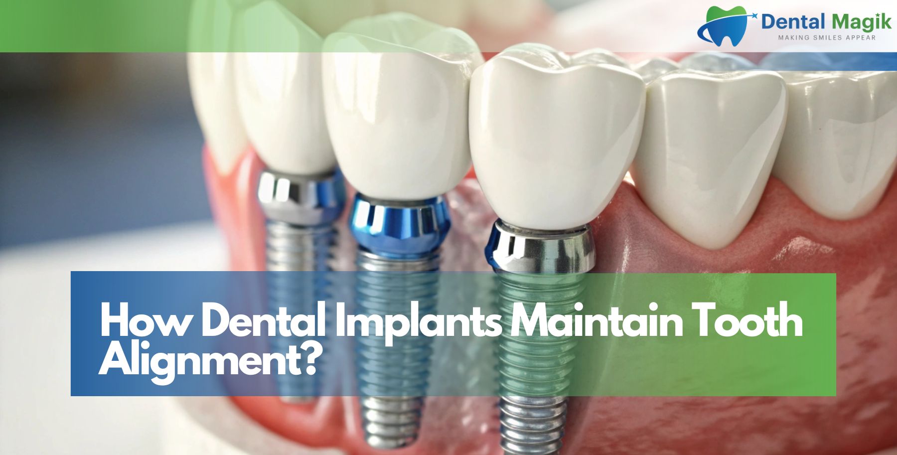 How Dental Implants Maintain Tooth Alignment?