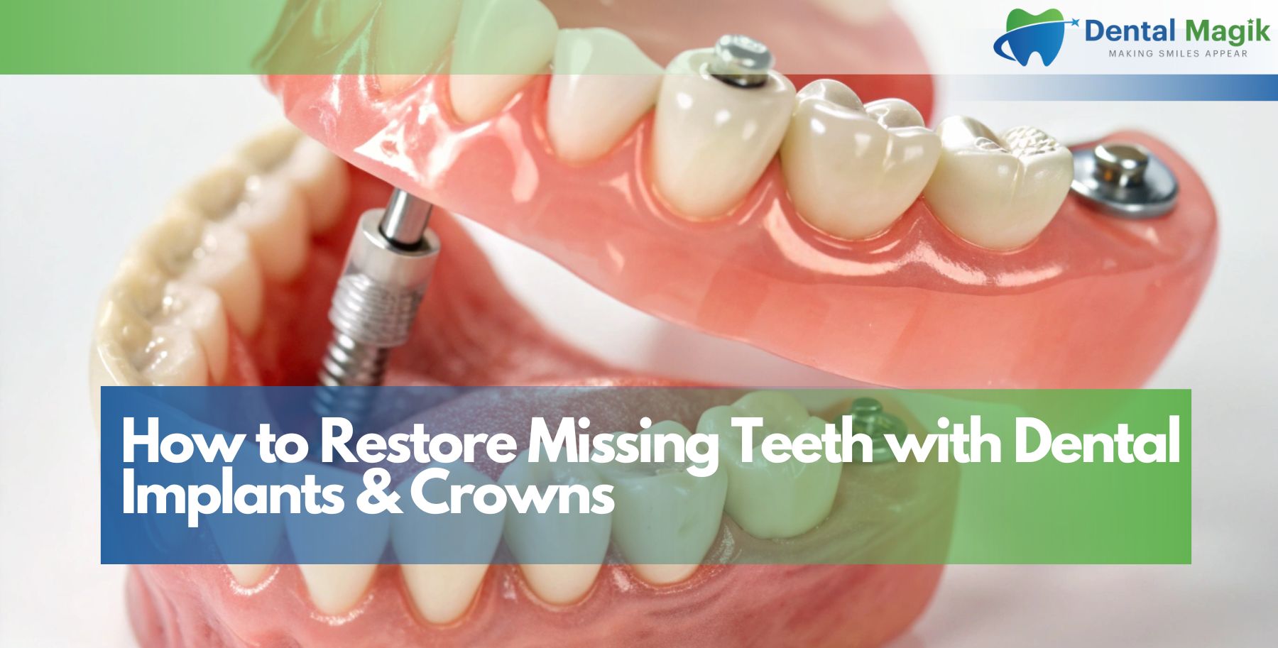 How to Restore Missing Teeth with Dental Implants & Crowns