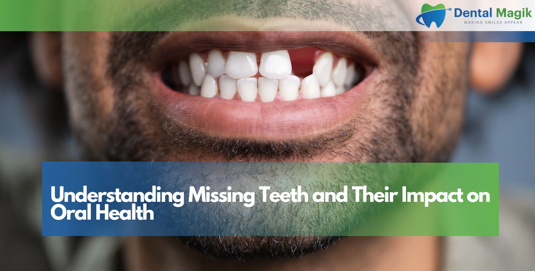 Understanding Missing Teeth and Their Impact on Oral Health