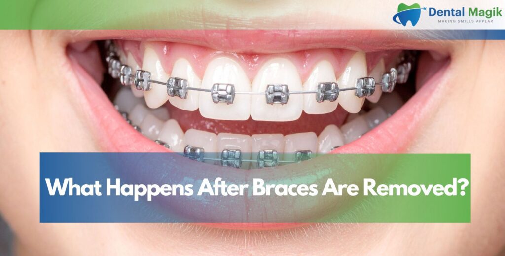 What Happens After Braces Are Removed?