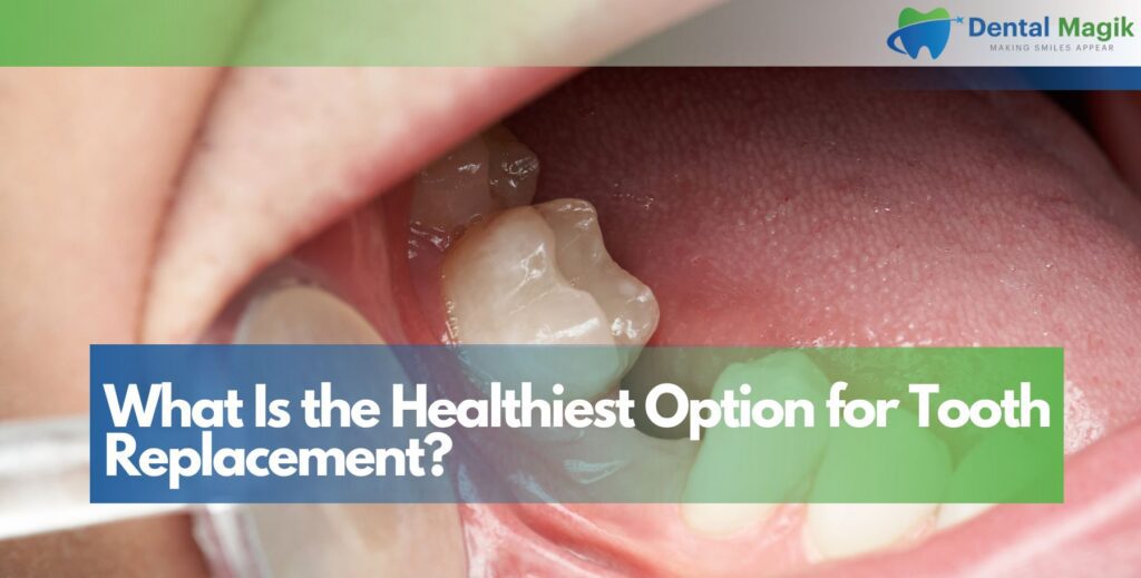 What Is the Healthiest Option for Tooth Replacement?