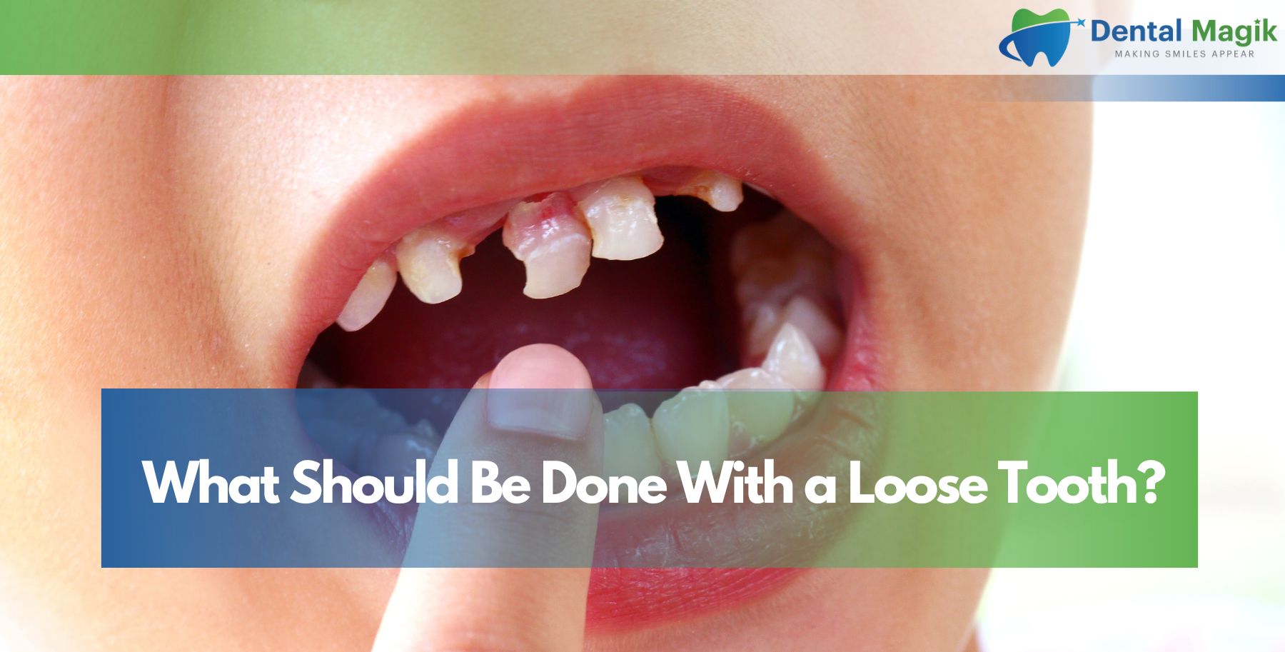 What Should Be Done With a Loose Tooth?