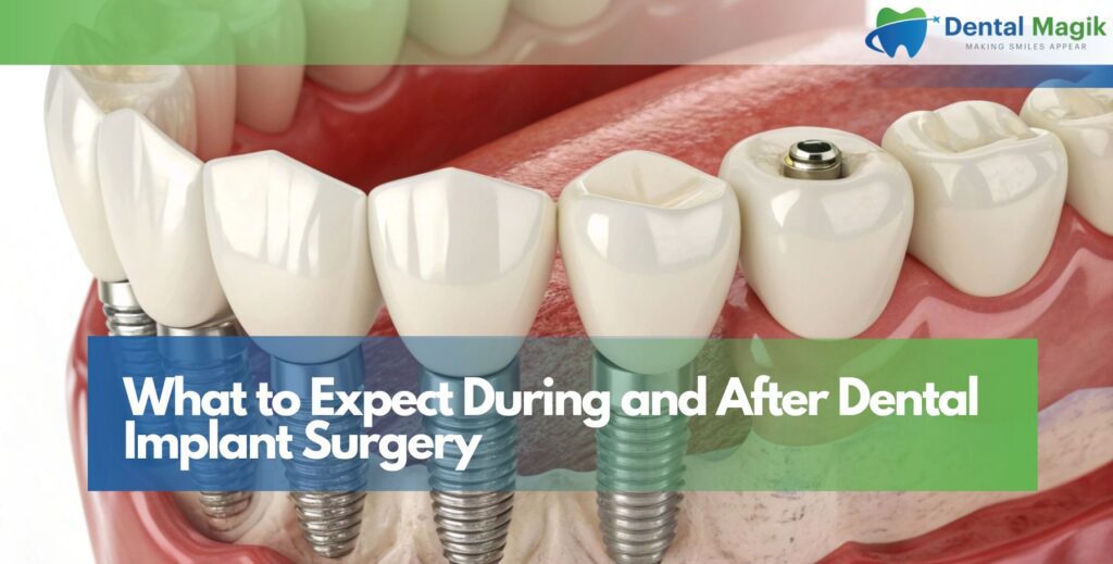 What to Expect During and After Dental Implant Surgery