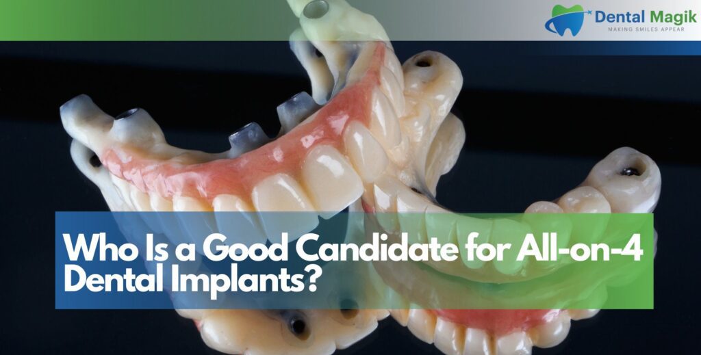 Who Is a Good Candidate for All-on-4 Dental Implants?