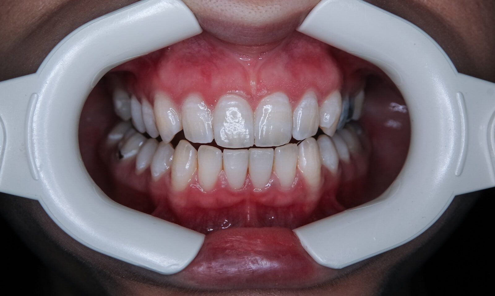 contact us (4) a person's mouth with teeth