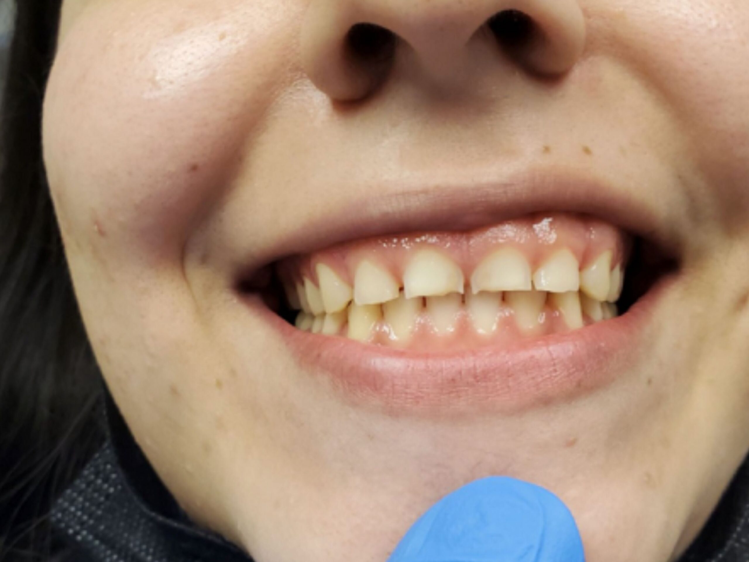 Before gummy smile correction and smile makeover