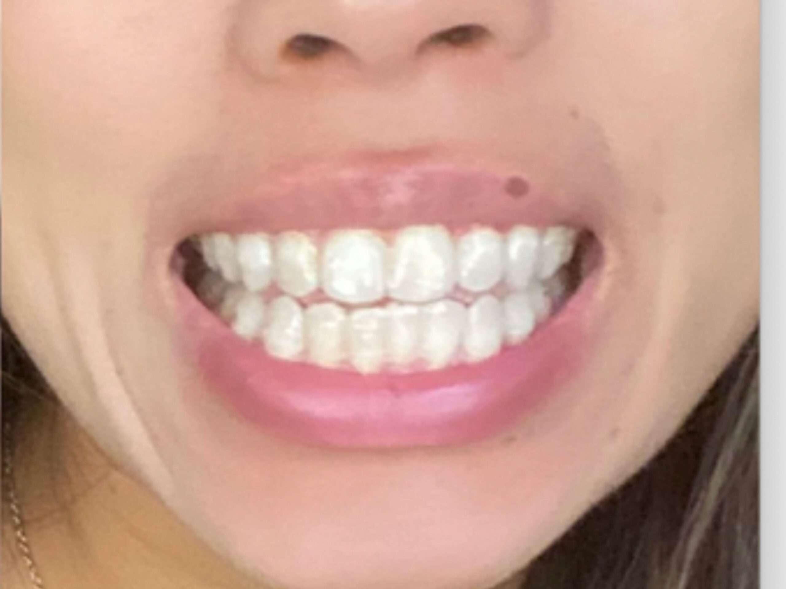 After Invisalign treatment