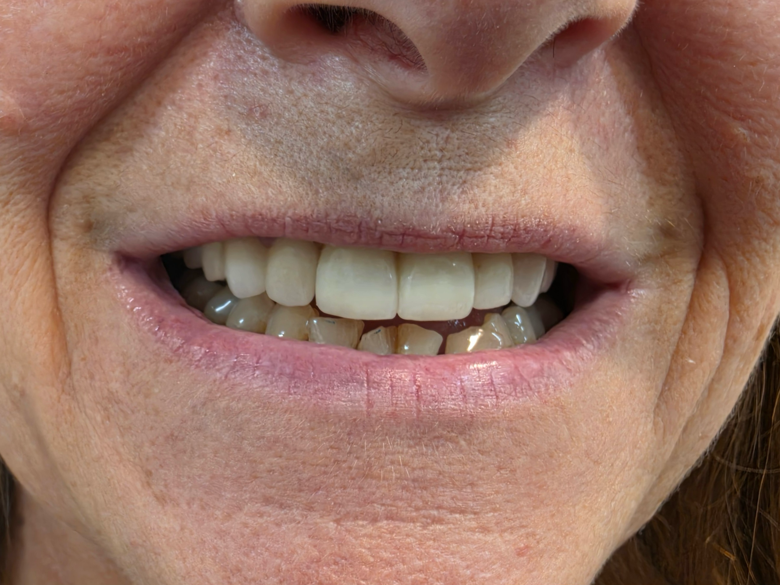 Patient smile before dental treatment