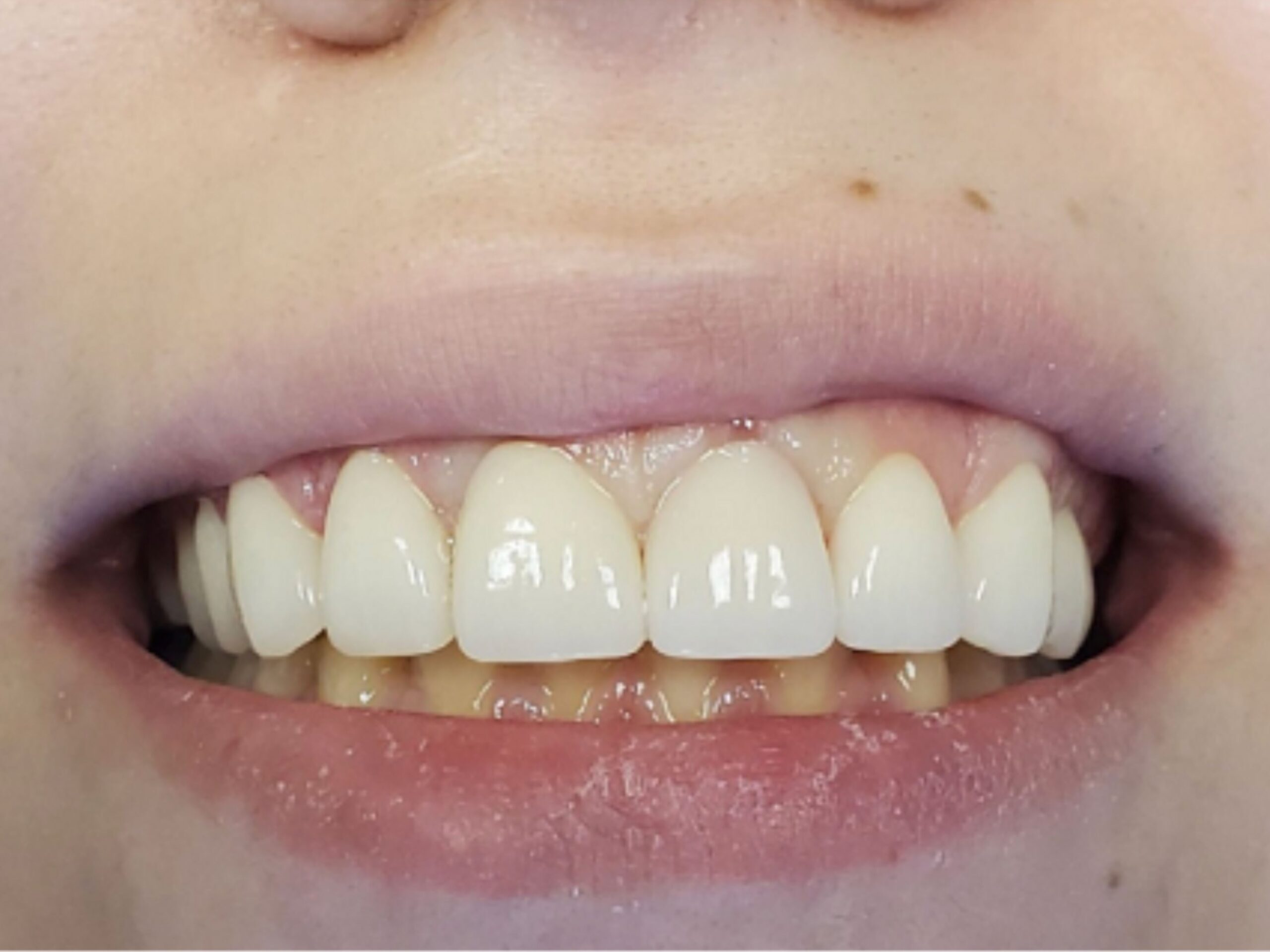 After gummy smile correction and smile makeover