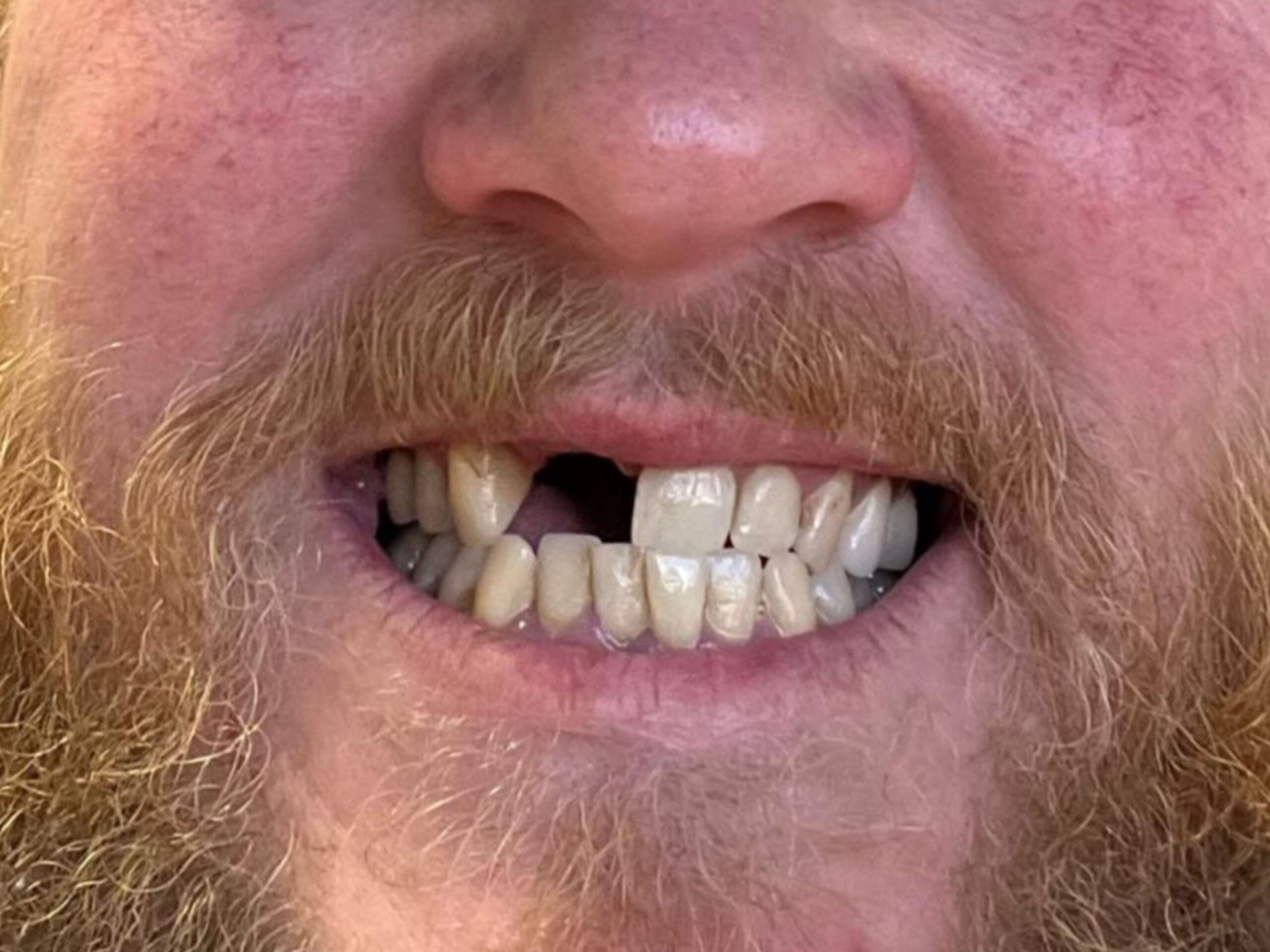 Before fixed bridge smile restoration