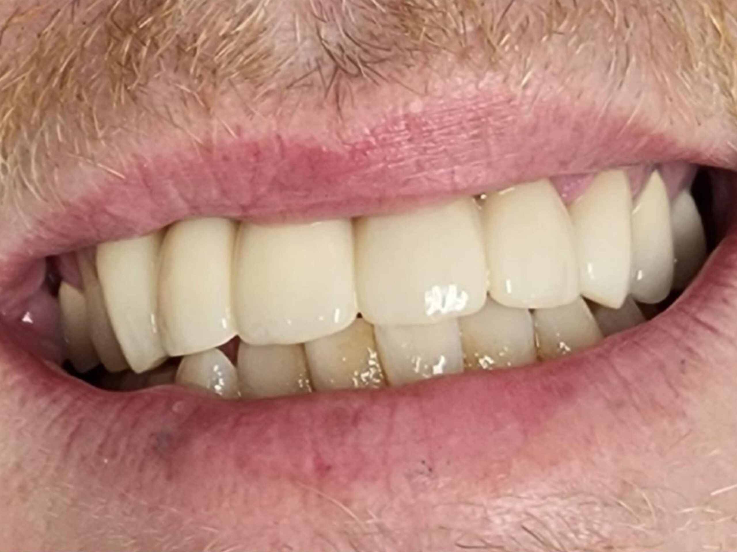 After fixed bridge smile restoration