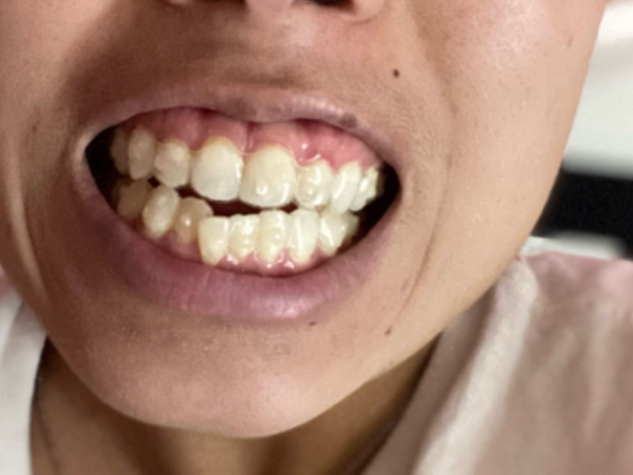 Before Invisalign treatment