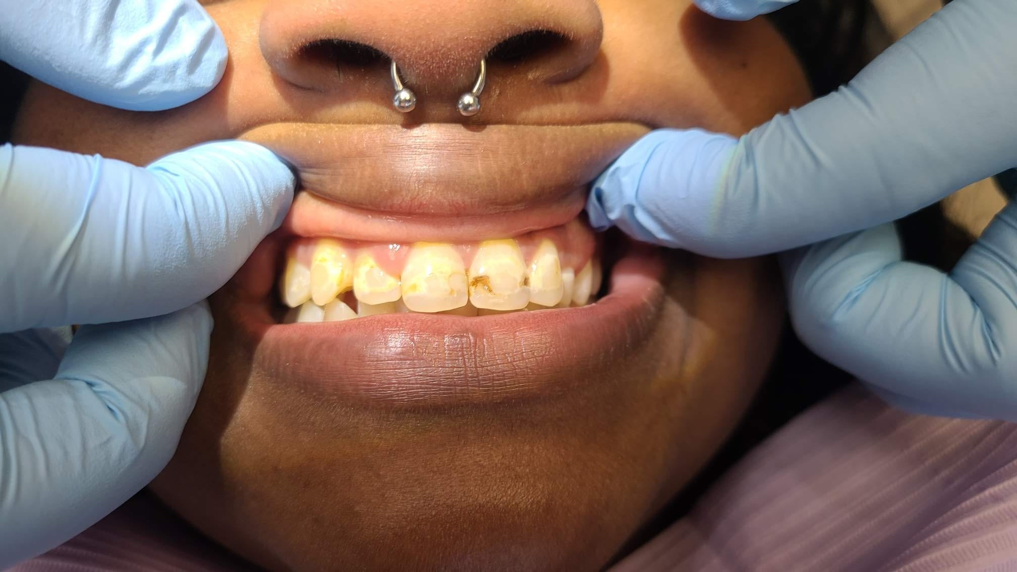 Before dental treatment