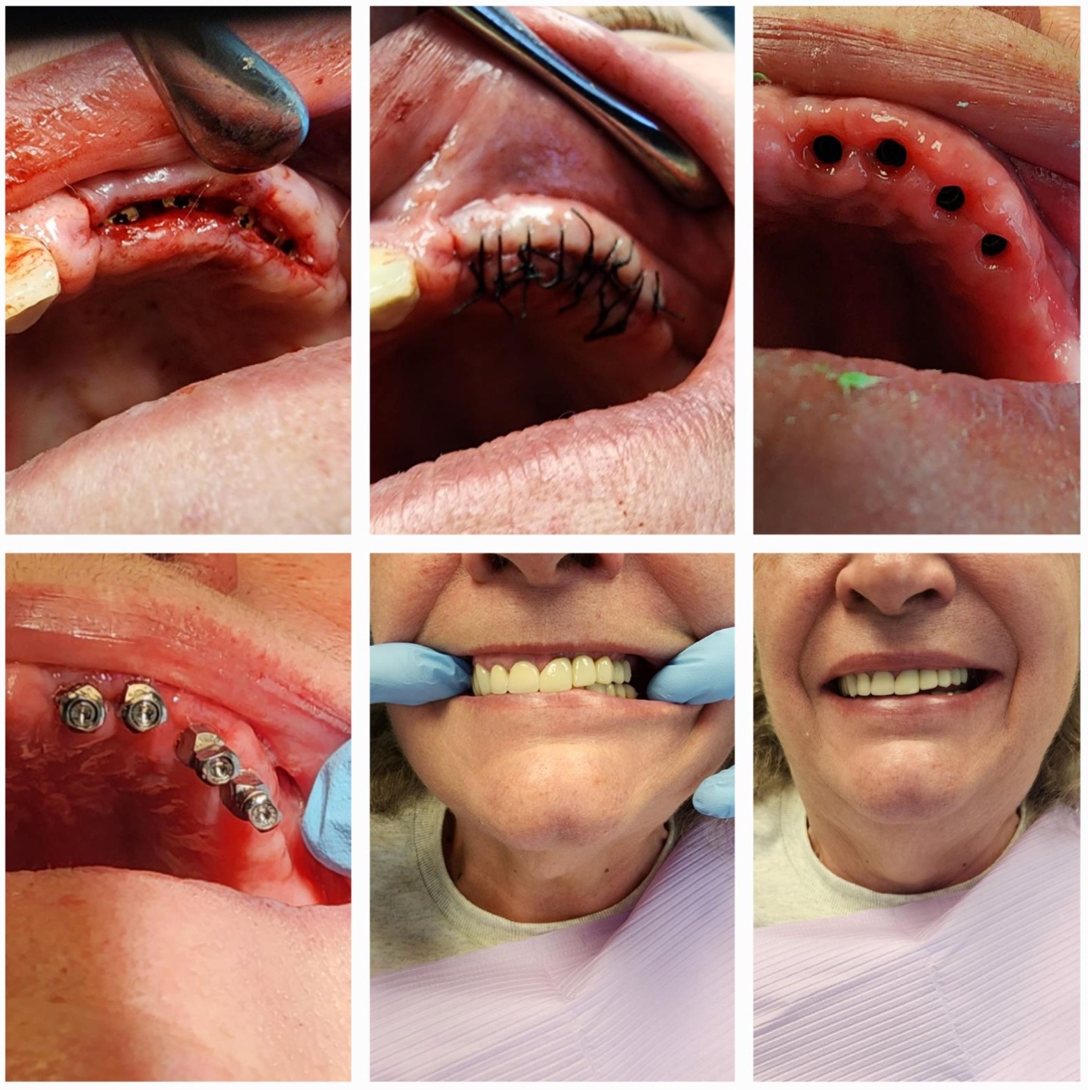 Implant-supported bridge result