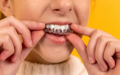 How Much Do Braces Cost Without Insurance?
